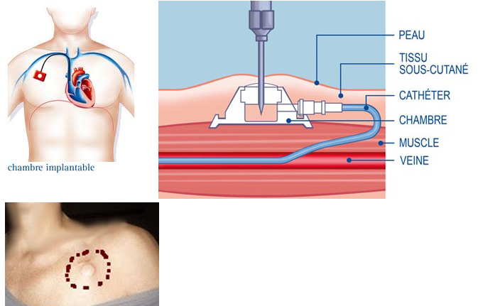 :  chambre implantable.png
: 5060
:  270.5 