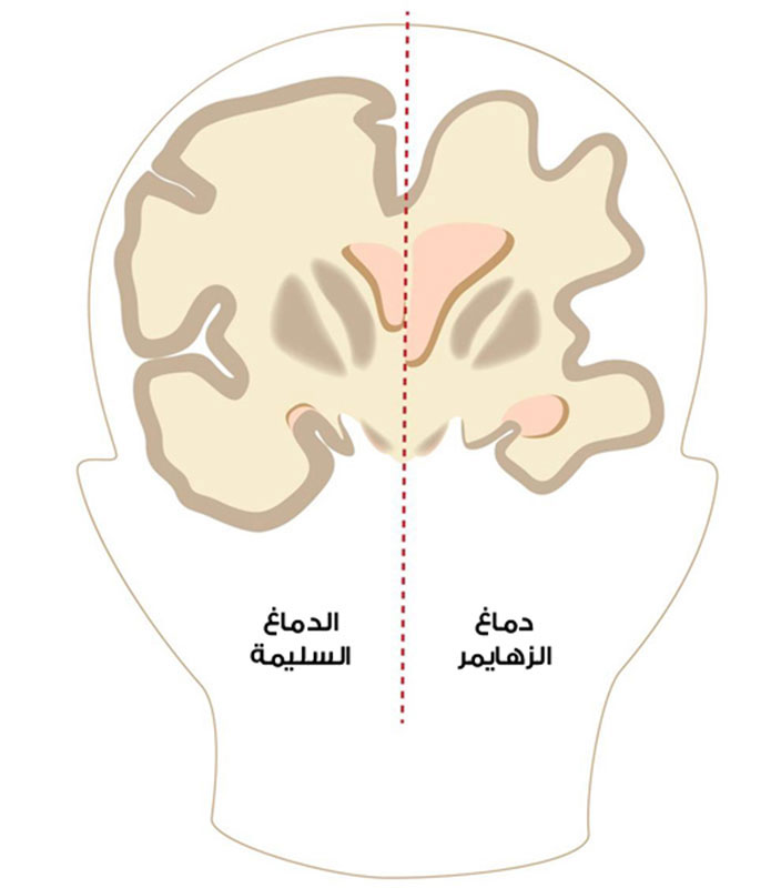 :  الزهايمر.jpg
: 582
:  40.5 